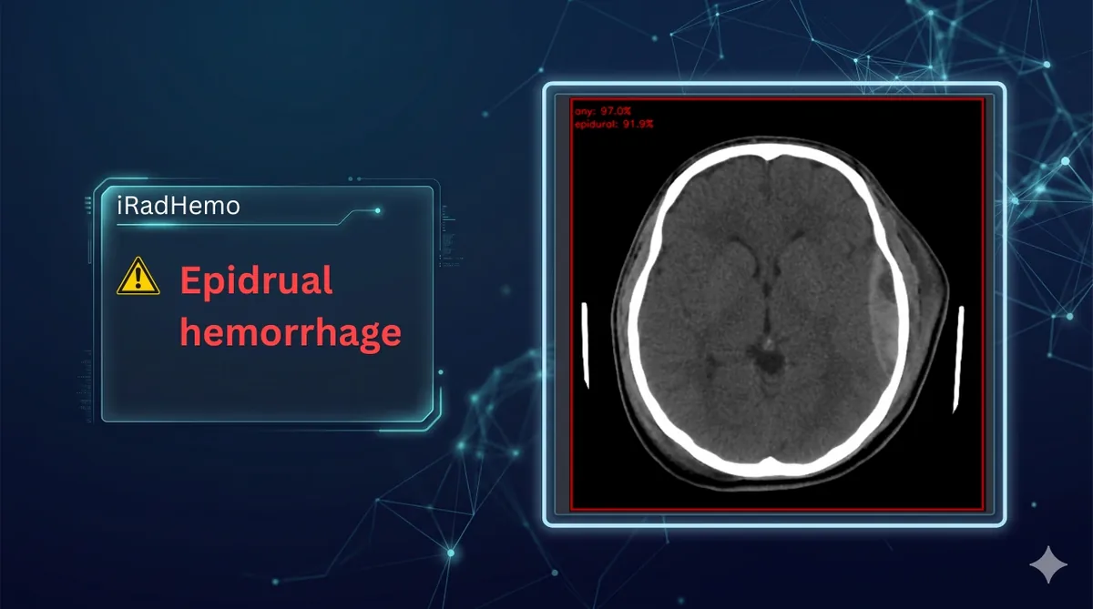 iRadHemo flagging an epidural haemorrhage on a head CT slice