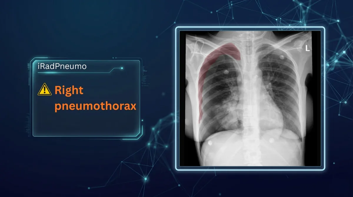 iRadPneumo marking a right pneumothorax on a chest X-ray