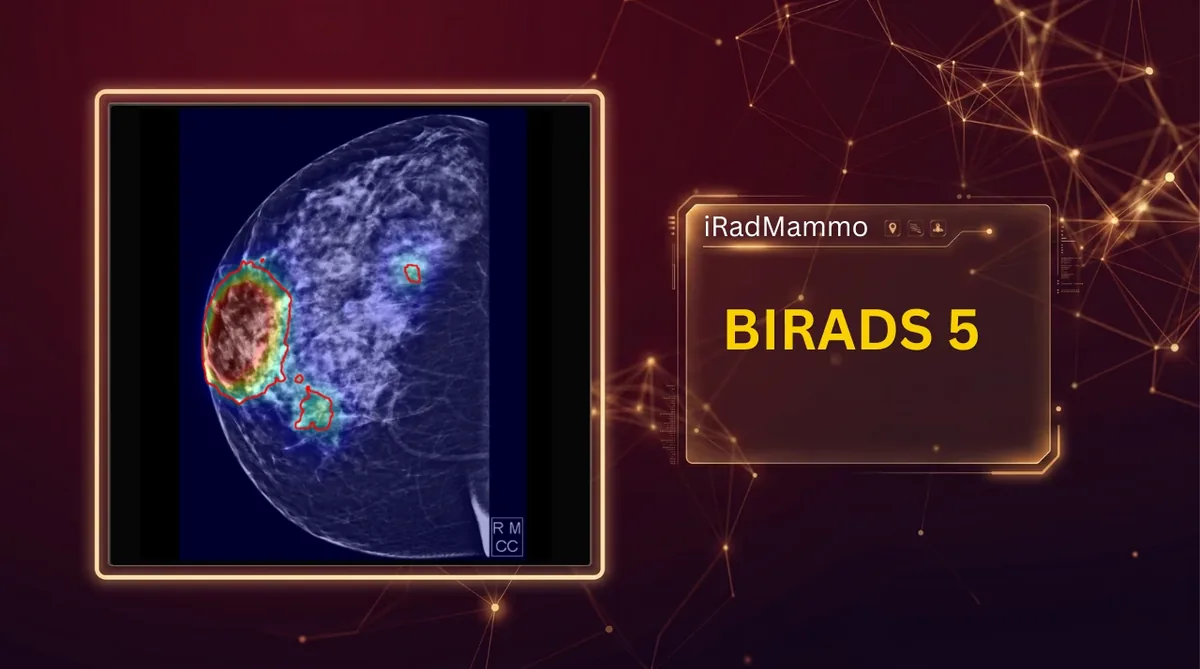 MammoRad heat map over a suspicious mammogram lesion graded BI-RADS 5