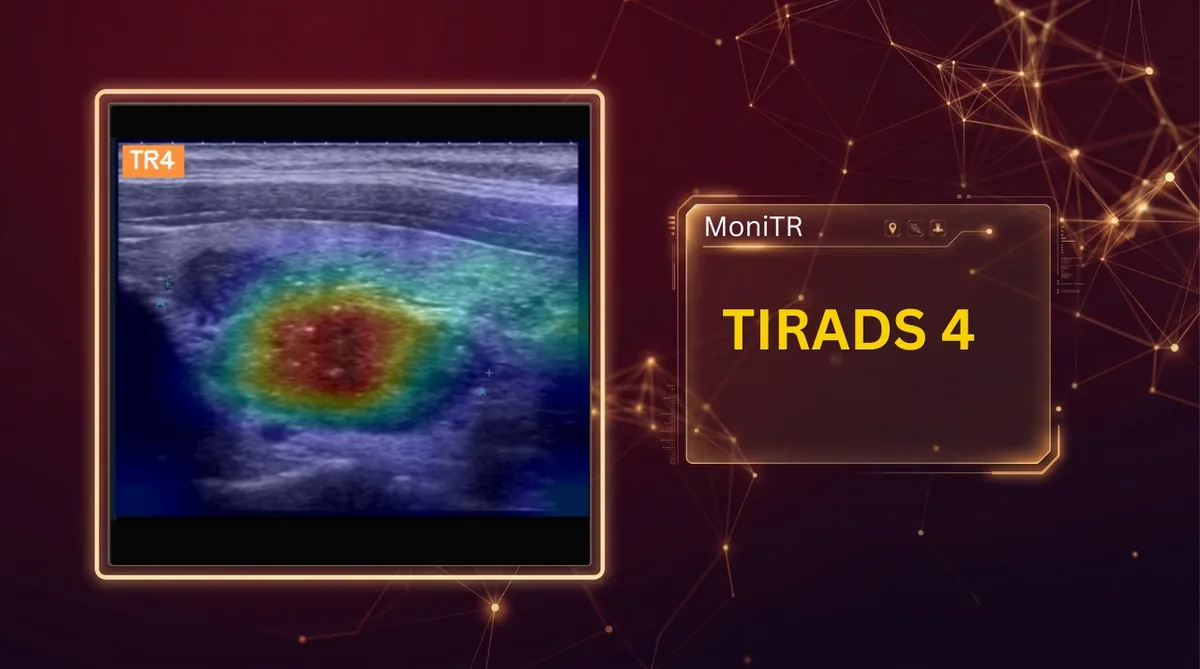 MoniTR heat map over a thyroid ultrasound nodule graded TI-RADS 4