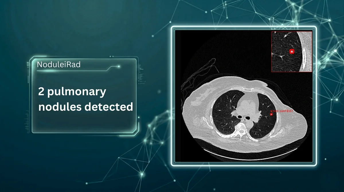 NoduleRad reporting two pulmonary nodules on a chest CT with a zoomed key image