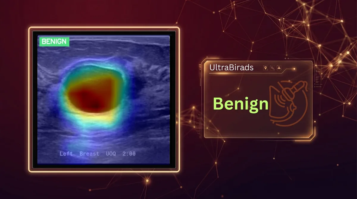 UltraBIRADS heat map over a breast ultrasound finding classified benign